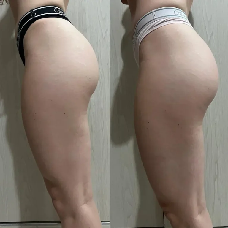 Antes despues de lado